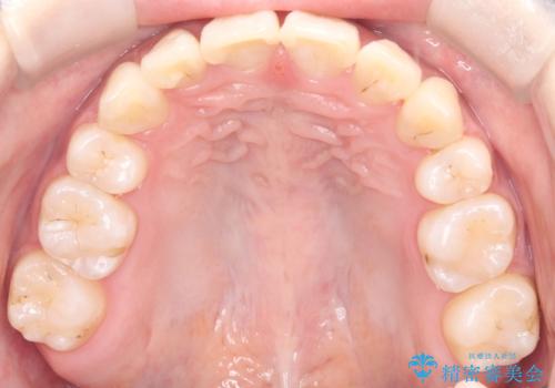 八重歯と正中のズレを解消!目立ちにくいワイヤー矯正で美しい歯並びへの治療後