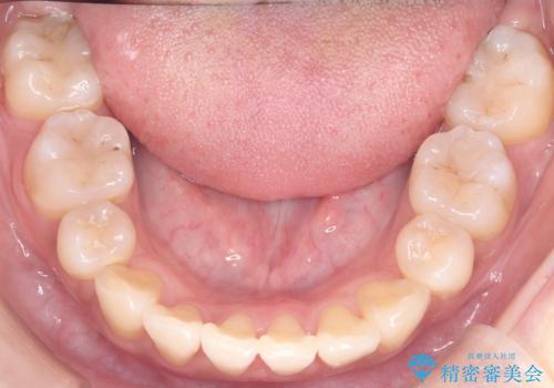 八重歯と正中のズレを解消!目立ちにくいワイヤー矯正で美しい歯並びへの治療後
