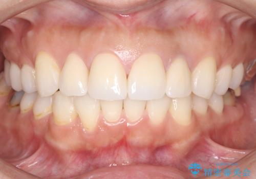 欠けて変色した前歯を一新!オールセラミックで叶える自然な笑顔の治療後