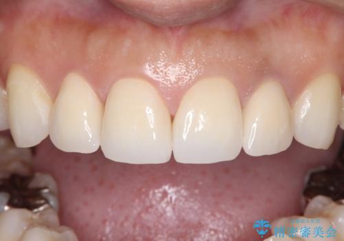 欠けて変色した前歯を一新!オールセラミックで叶える自然な笑顔の治療後