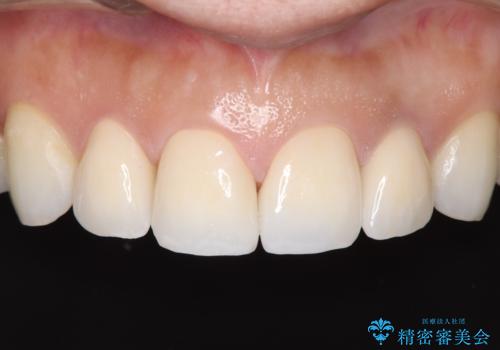 欠けて変色した前歯を一新!オールセラミックで叶える自然な笑顔の治療後