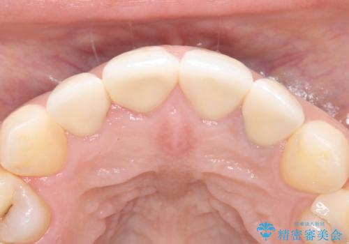 欠けて変色した前歯を一新!オールセラミックで叶える自然な笑顔の治療後