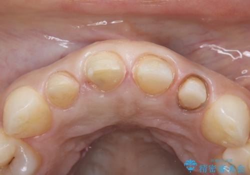 欠けて変色した前歯を一新!オールセラミックで叶える自然な笑顔の治療中