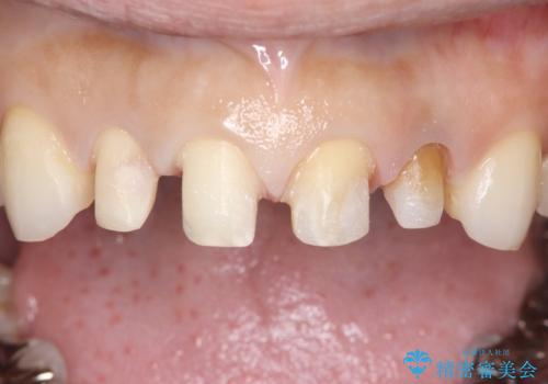 欠けて変色した前歯を一新!オールセラミックで叶える自然な笑顔の治療中