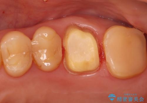 奥歯の痛みを根本から解消し、クラウンで歯の強度を回復の治療中