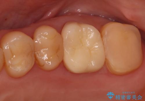 奥歯の痛みを根本から解消し、クラウンで歯の強度を回復の治療後