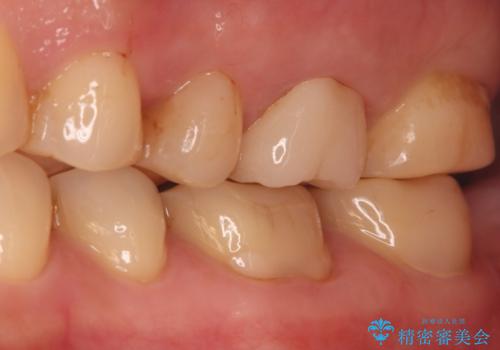 奥歯の痛みを根本から解消し、クラウンで歯の強度を回復の治療後