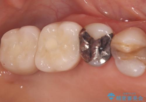 重度歯周病で失った奥歯2本を、抜歯即時インプラントで早期回復の治療後