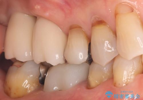 重度歯周病で失った奥歯2本を、抜歯即時インプラントで早期回復の治療後