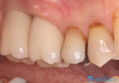 重度歯周病で失った奥歯2本を、抜歯即時インプラントで早期回復の治療後