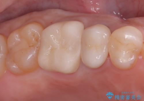 奥歯の銀歯を美しく一新!歯の破折を防ぐセラミッククラウンの治療後