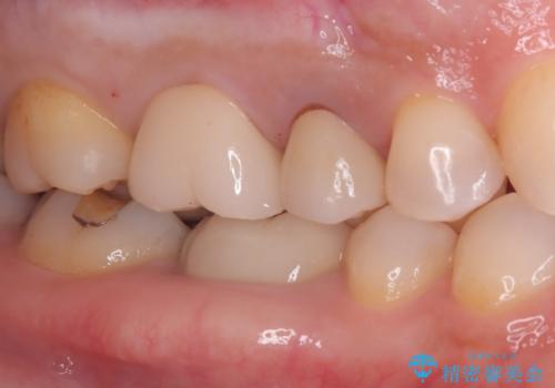 奥歯の銀歯を美しく一新!歯の破折を防ぐセラミッククラウンの治療後