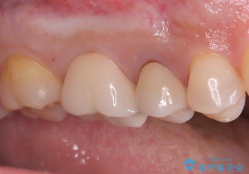 奥歯の銀歯を美しく一新!歯の破折を防ぐセラミッククラウンの治療後