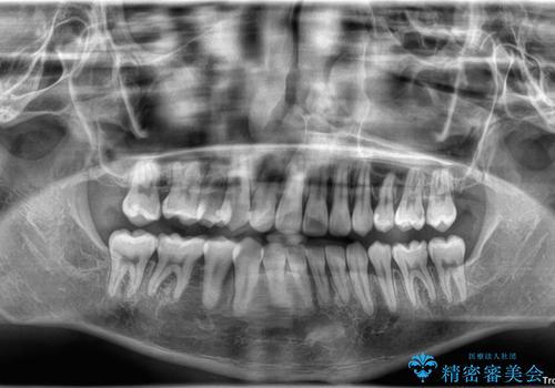 抜歯矯正で叢生と正中のずれを改善|審美装置による矯正症例の治療後