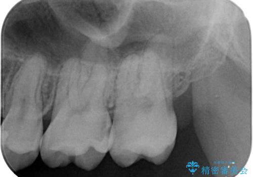 抜歯矯正で叢生と正中のずれを改善|審美装置による矯正症例の治療前