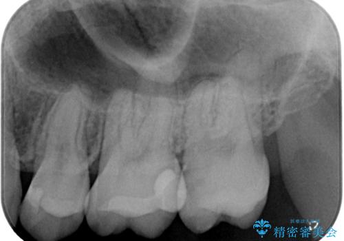 抜歯矯正で叢生と正中のずれを改善|審美装置による矯正症例の治療後