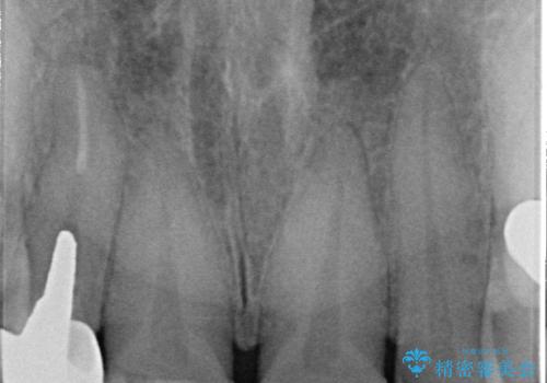適合不良のラミネートベニアをやり替えて自然な笑顔に|オールセラミッククラウンによる前歯補綴症例の治療前