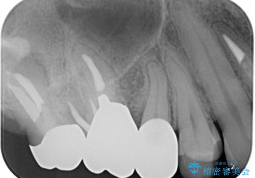 欠けた詰め物を精密セラミックインレーで自然に修復した症例の治療前