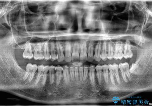 目立たない矯正で正中離開と下の前歯のデコボコを改善|インビザラインによる治療症例の治療後