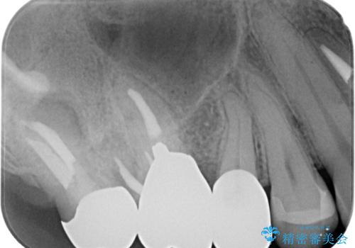 欠けた詰め物を精密セラミックインレーで自然に修復した症例の治療後