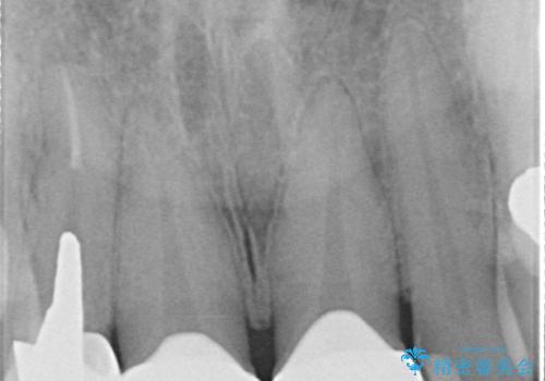 適合不良のラミネートベニアをやり替えて自然な笑顔に|オールセラミッククラウンによる前歯補綴症例の治療後