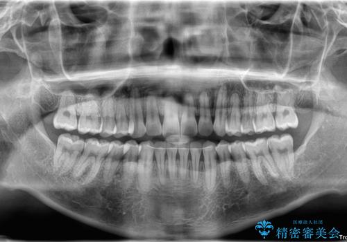 矯正後の後戻りをインビザラインライトで再治療|目立たない矯正の症例紹介の治療後