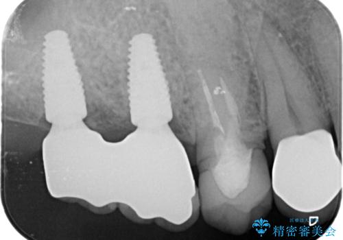 奥歯でしっかりと咬みたい 咬合機能をしっかりと回復するインプラント治療の治療後