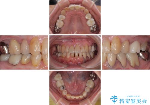 長年気になっていた前歯　矯正治療と補綴治療による審美歯科治療の治療後