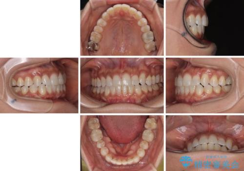 クロスバイトを治したい インビザラインによる矯正治療の治療後