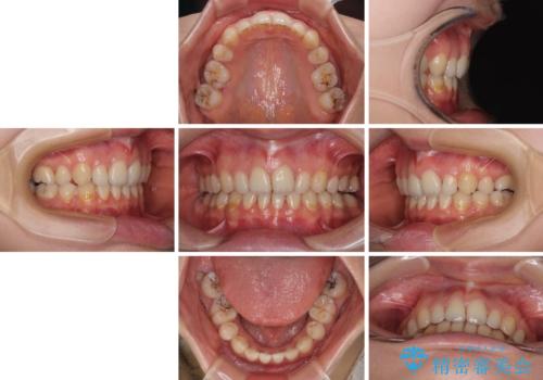 欠損や残存乳歯、深い咬み合わせ　ワイヤー矯正で咬合改善の治療後