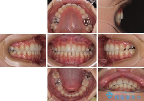 【モニター】閉じにくい前歯とクロスバイト　ワイヤー装置での抜歯矯正の治療後