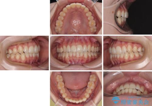 気になる前歯と咬み合わせを改善　インビザライン・モデレートの治療後