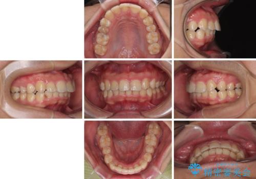 左右に顎がずれた咬み合わせ ワイヤー矯正で咬み合わせを改善の治療後