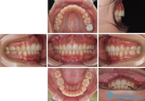 【モニター】唇が閉じにくい ワイヤー装置での抜歯矯正の治療後