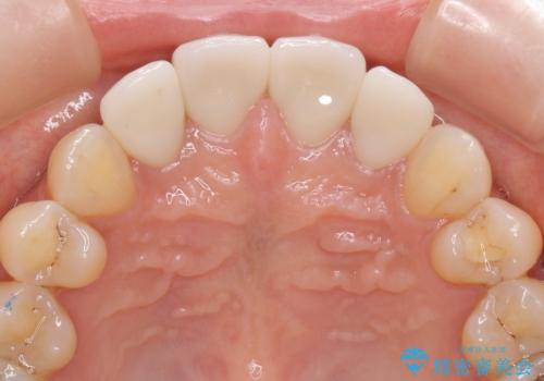 前歯の劣化したコンポジットレジン修復をセラミッククラウンへの治療後