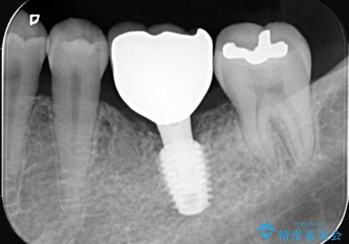 根尖性歯周炎|分岐部病変|パーフォレーション|インプラントで治療の治療後
