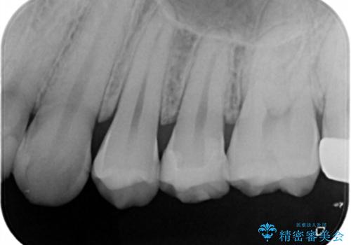 虫歯を治療したい セラミックインレーの治療後