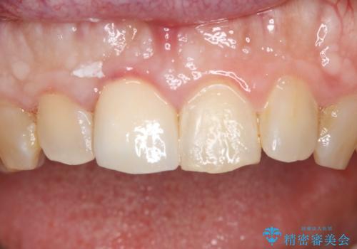 前歯が欠けたので綺麗にしたい オールセラミッククラウンの治療後