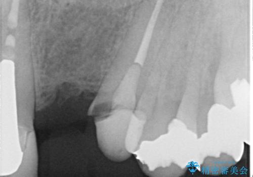 【セラミッククラウン】【エクストリュージョン】抜歯はしたくないの治療前