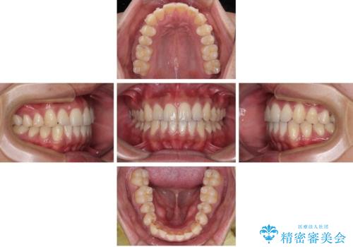 矯正後の後戻りをインビザラインライトで再治療|目立たない矯正の症例紹介の治療中