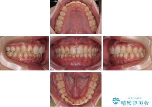 目立たない矯正で正中離開と下の前歯のデコボコを改善|インビザラインによる治療症例の治療中