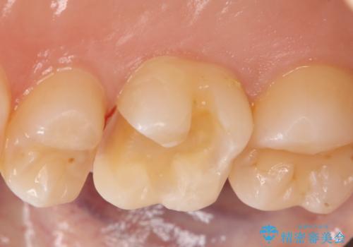 虫歯をしっかり治したい　セラミックインレーの治療中