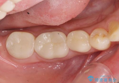 { 歯周外科 } 骨隆起除去を含む歯冠長延長術の治療後