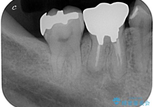 銀の詰め物を白くしたいの治療前