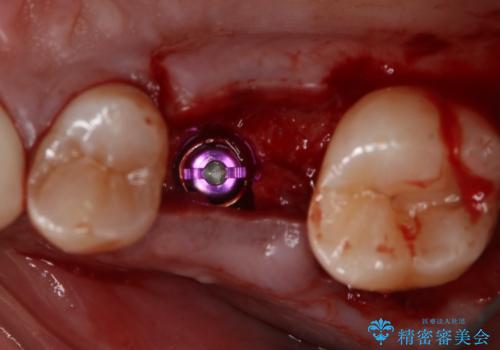 歯を入れたい　インプラント+セラミッククラウンの治療中