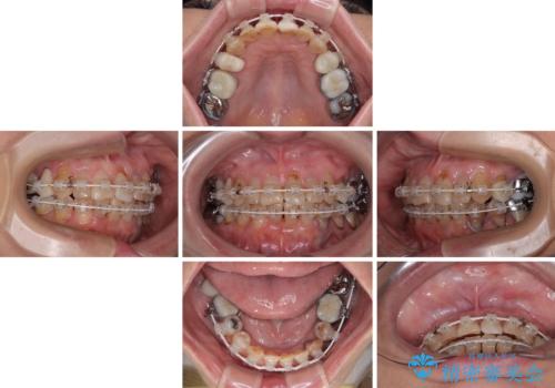 長年気になっていた前歯 矯正治療と補綴治療による審美歯科治療の治療中