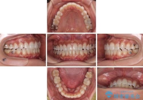 クロスバイトを治したい　インビザラインによる矯正治療の治療中