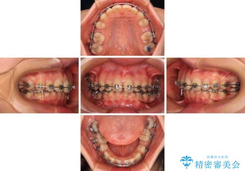欠損や残存乳歯、深い咬み合わせ ワイヤー矯正で咬合改善の治療中