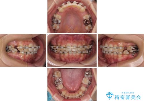 【モニター】閉じにくい前歯とクロスバイト ワイヤー装置での抜歯矯正の治療中