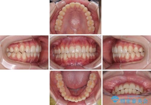 気になる前歯と咬み合わせを改善　インビザライン・モデレートの治療中